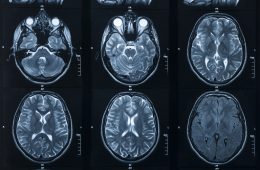 Photo of brain MRIs