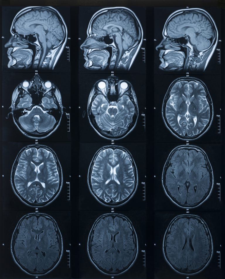 Photo of brain MRIs