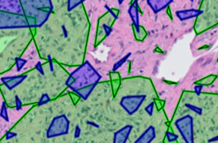 a digital image showing head-and-neck cancer cells