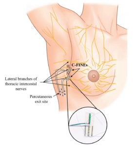Illustration of implantable breast technology showing where the C-FINEs are relative o the lateral branches of thoracic intercostal nerves and the percutaneous exit site