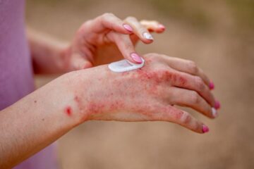 Close up of woman with eczema applying ointment. Courtesy of Getty Images.