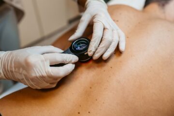 Photo of a doctor examining a patient's birthmarks for skin cancer in a medical clinic. Courtesy of Getty Images.