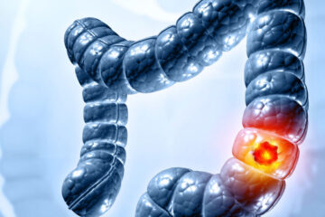 Photo illustration of a highlighted portion of the colon to depict colorectal cancer