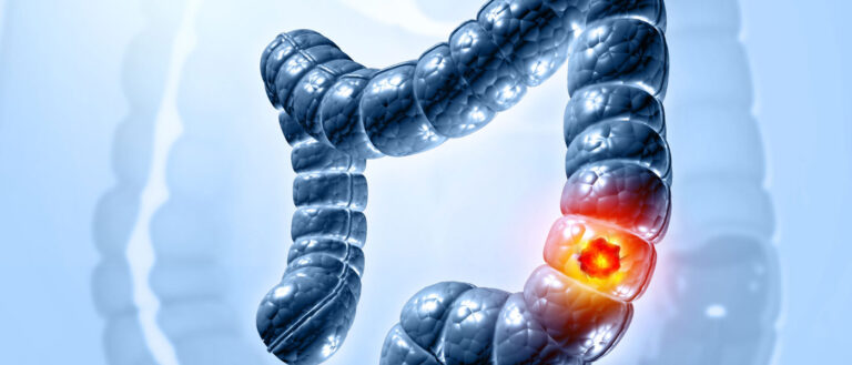 Photo illustration of a highlighted portion of the colon to depict colorectal cancer