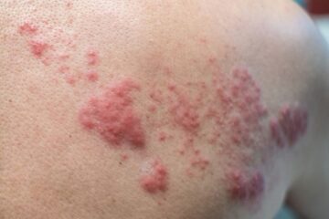 Close up of shingles rash, courtesy of Getty Images.