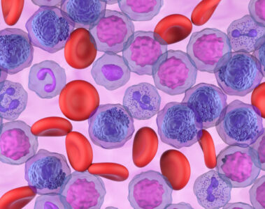 Microscopic view 3d illustration of acute myeloid leukemia (AML) cells in blood flow