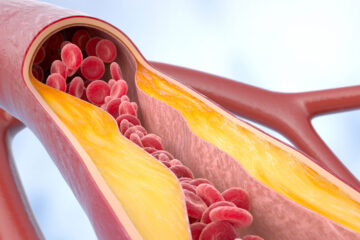 Photo illustration showing the inside of an artery that is clogged with plaque and limiting the flow of blood cells