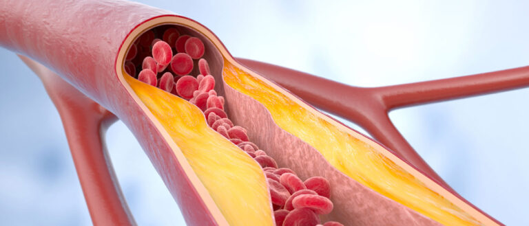 Photo illustration showing the inside of an artery that is clogged with plaque and limiting the flow of blood cells