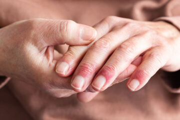 Close up photo on a woman's hands with red splotches on her fingers