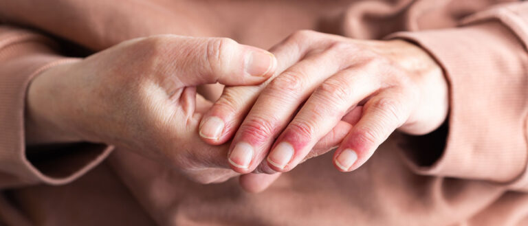 Close up photo on a woman's hands with red splotches on her fingers