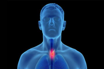 3D Illustration of esophageal cancer in the human male