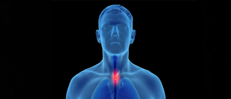 3D Illustration of esophageal cancer in the human male